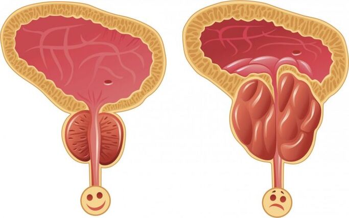 malusog at namamagang prosteyt na may prostatitis