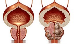 Malusog at masama sa katawan prostate