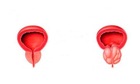 malusog at namamagang prosteyt na may prostatitis