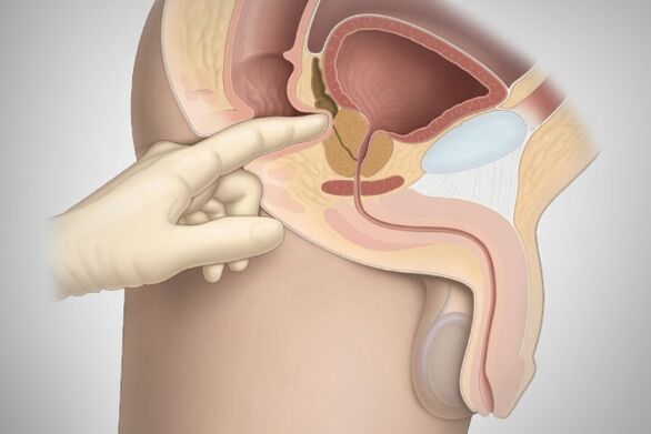 Prostate massage para sa bacterial prostatitis
