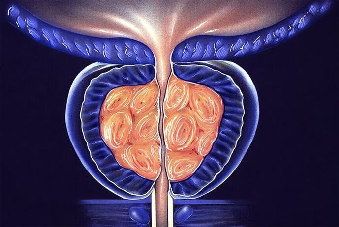 sintomas at paggamot ng prostatitis