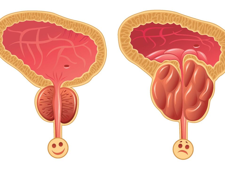 Malusog na prostate gland at prostate congestion na may congestive prostatitis