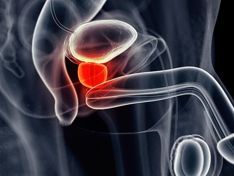 Pamamaga ng prostate gland na kasama ng talamak na prostatitis