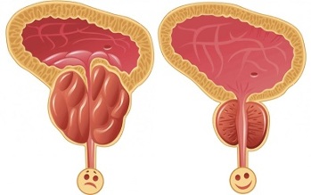 paano gumagana ang ProstEro prostatitis bago at pagkatapos ng paggamot